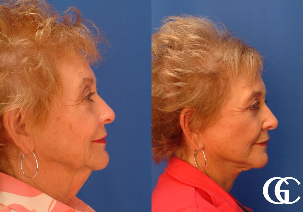 Facelift - Thumbnail 3