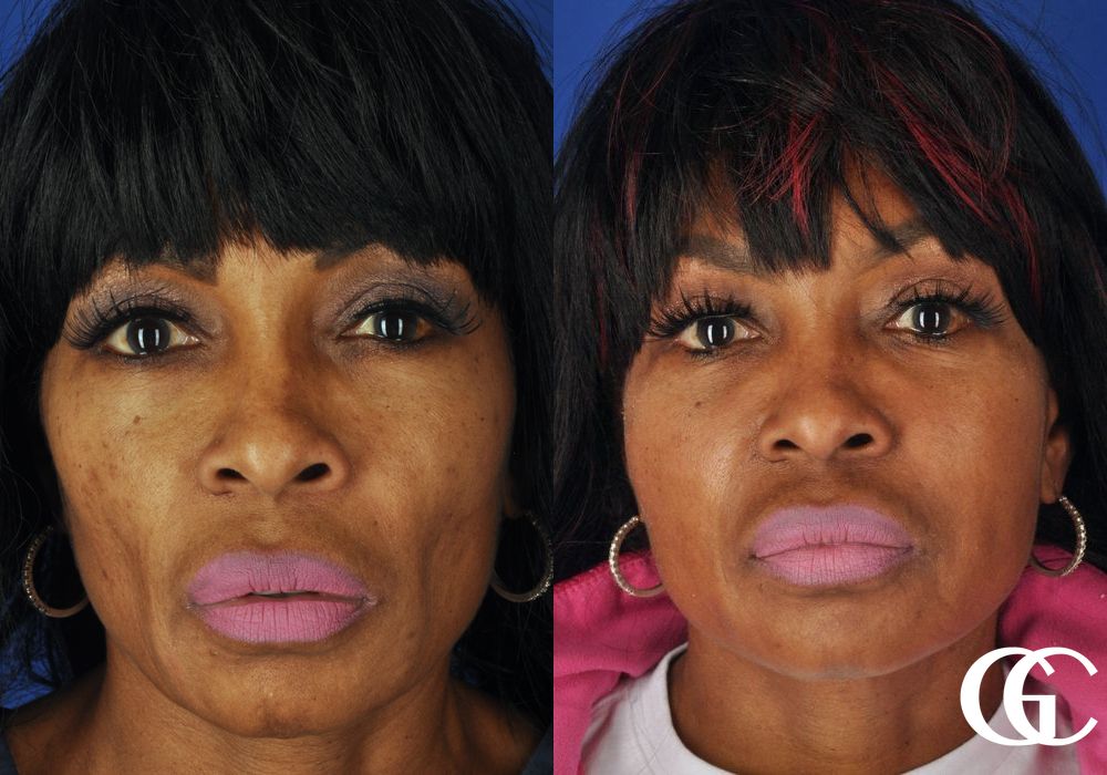 Facelift - Case 7412