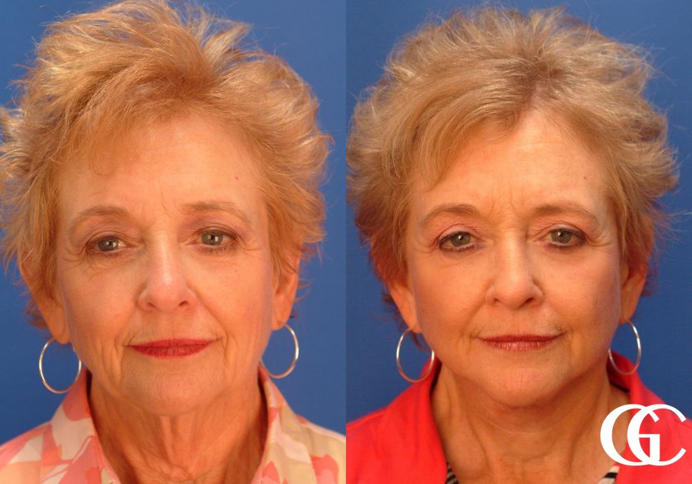 Facelift - Case 7413