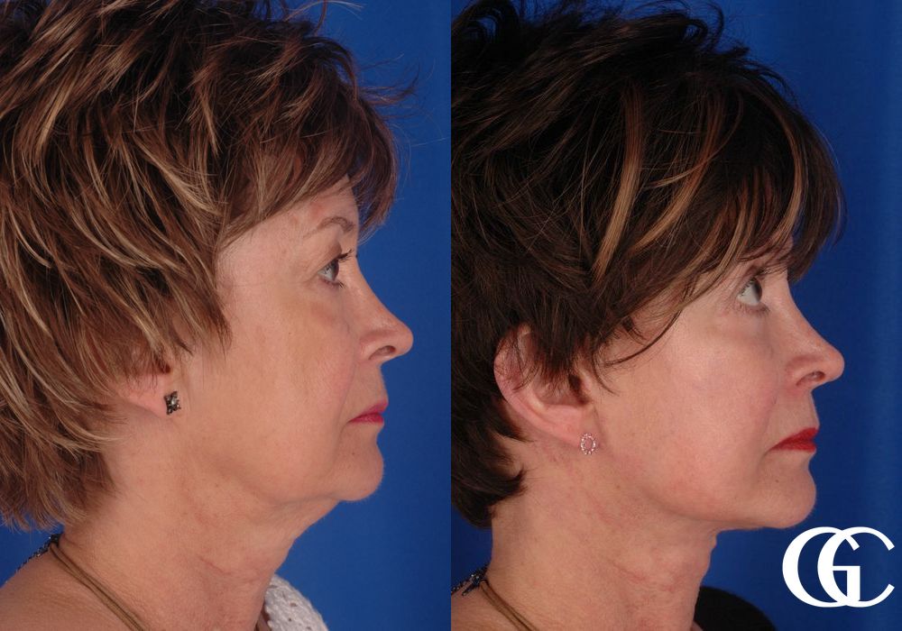 Facelift - Thumbnail 3