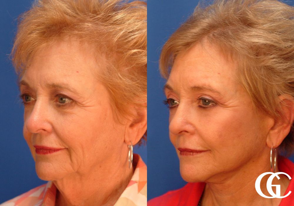 Facelift - Thumbnail 2