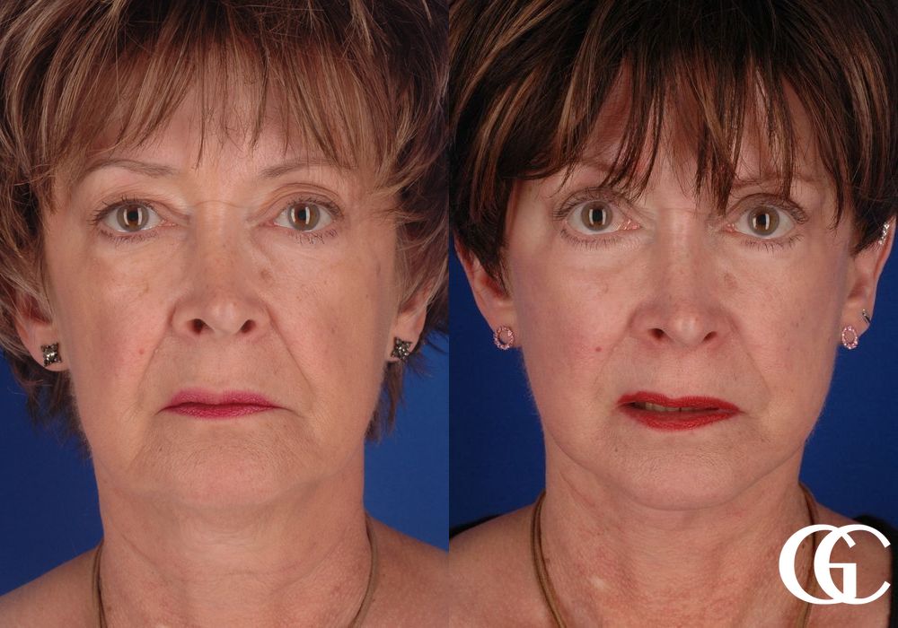 Facelift - Case 7407