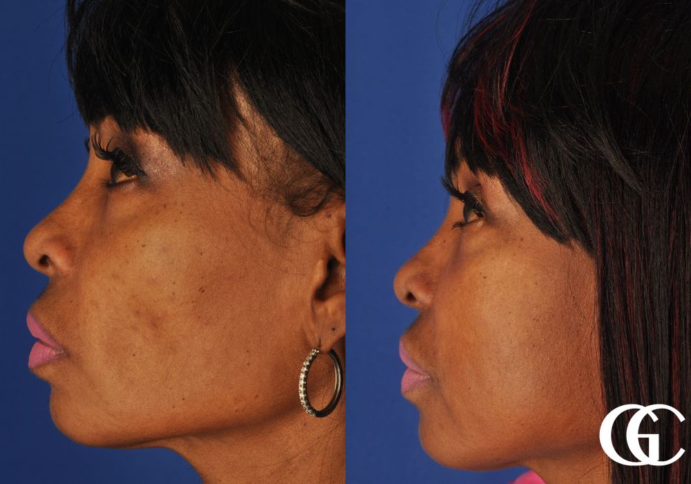 Facelift - Thumbnail 4