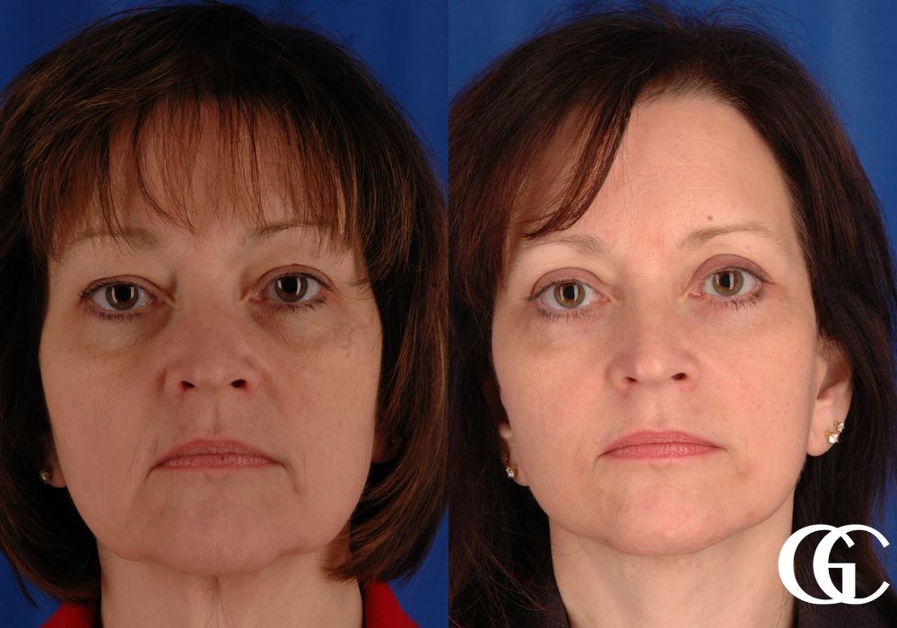 Facelift - Case 7409