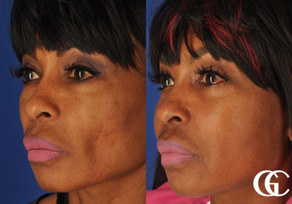 Facelift - Thumbnail 2