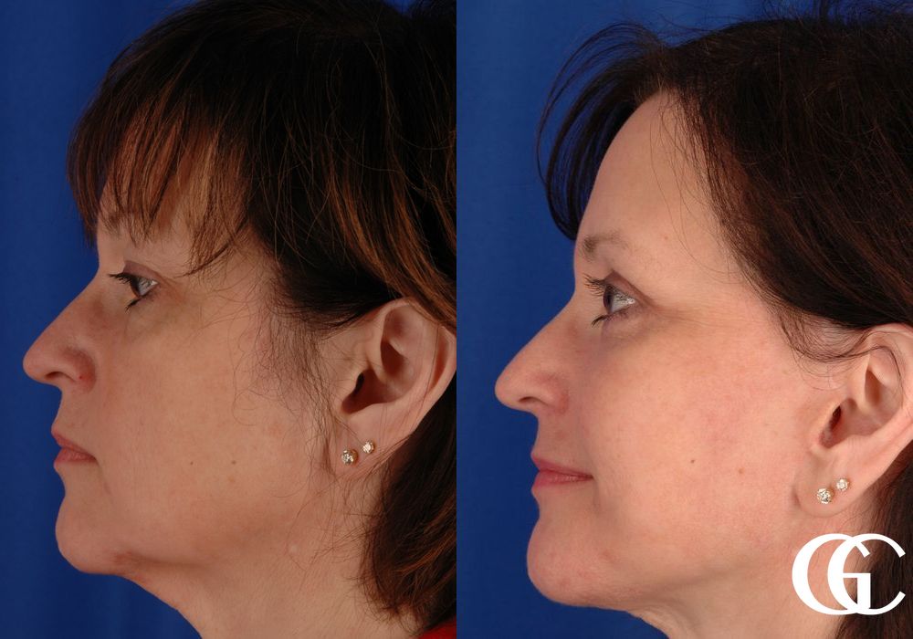 Facelift - Thumbnail 3