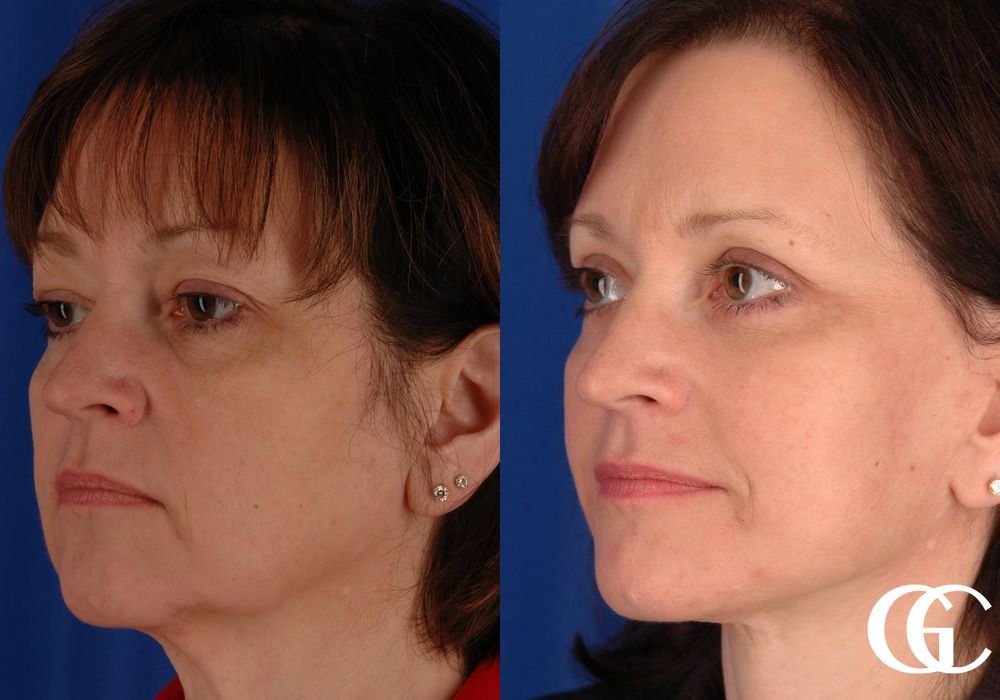 Facelift - Thumbnail 5