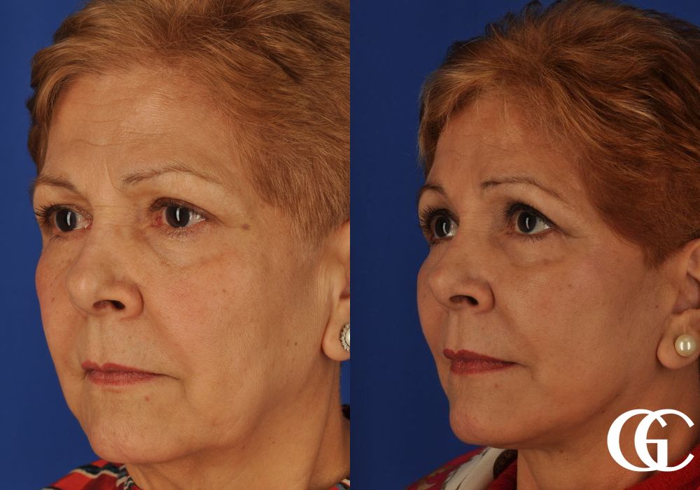 Facelift - Thumbnail 3