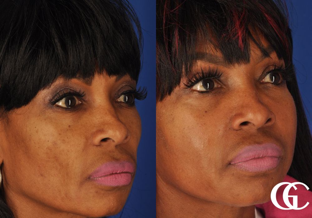 Facelift - Thumbnail 5