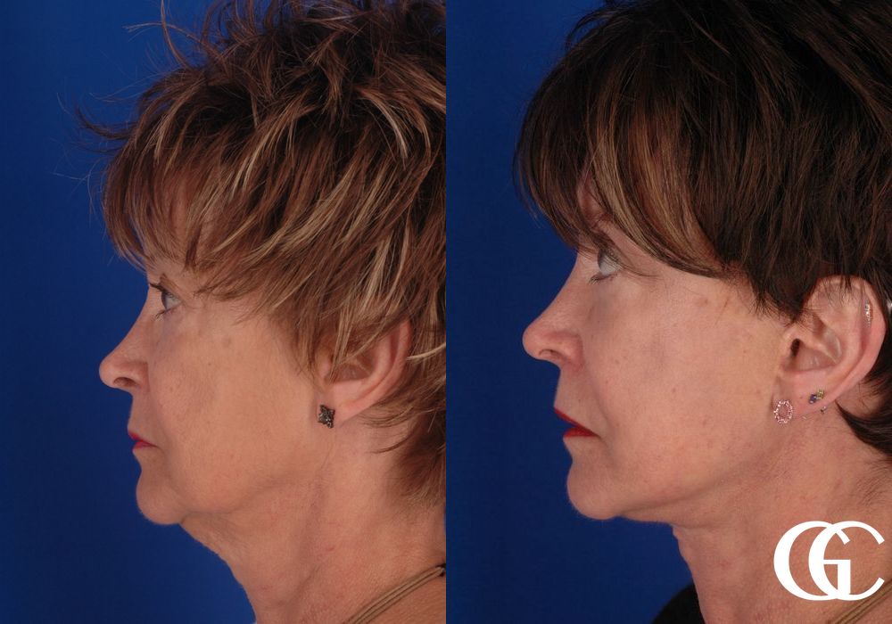 Facelift - Thumbnail 5