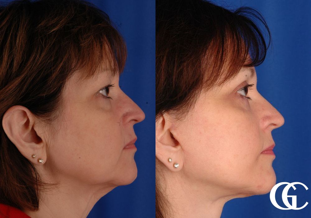 Facelift - Thumbnail 2