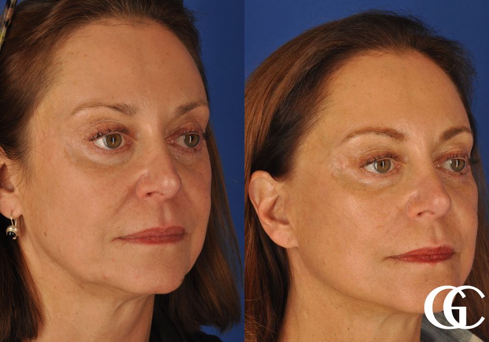 Facelift & Neck Lift - Thumbnail 4