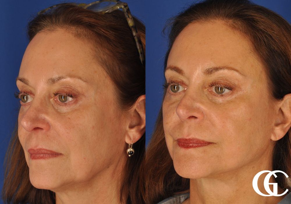 Facelift & Neck Lift - Case 7416