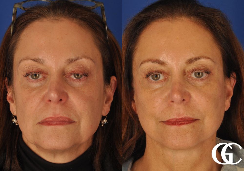 Facelift & Neck Lift - Thumbnail 2