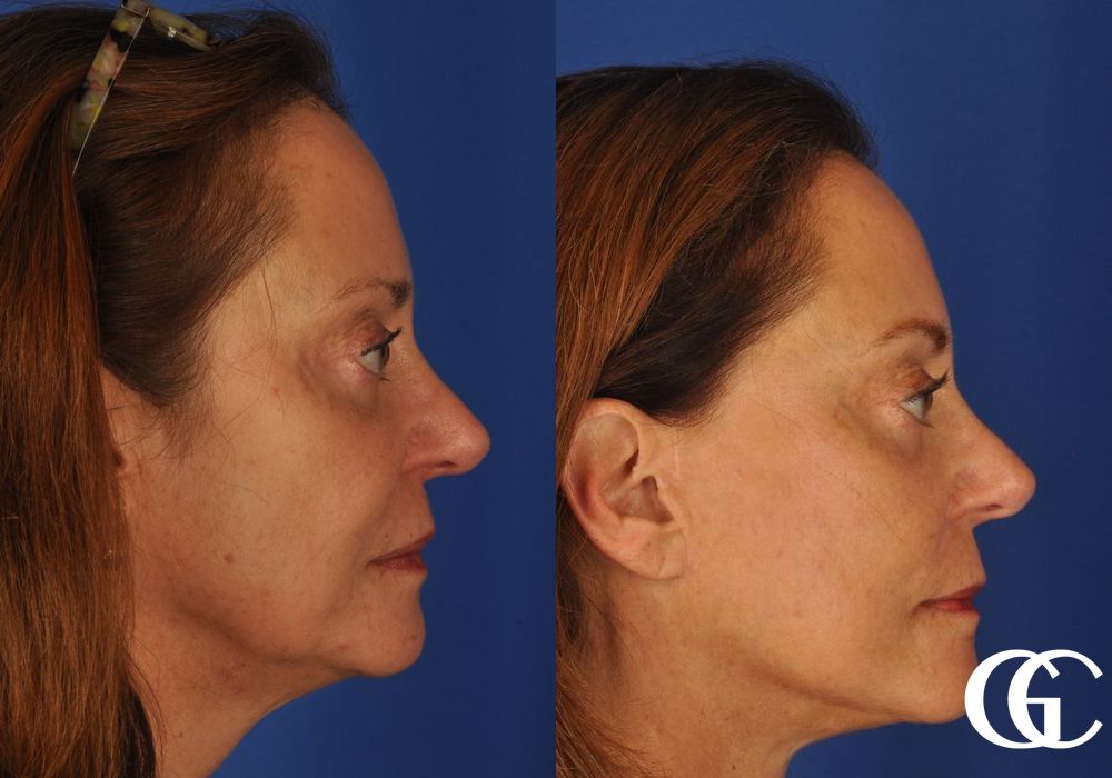 Facelift & Neck Lift - Thumbnail 3