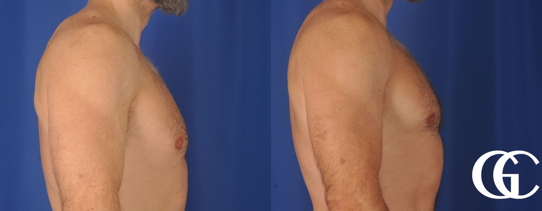 Gynecomastia - Case 7387