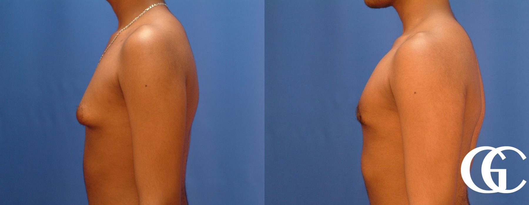 Gynecomastia - Case 7383