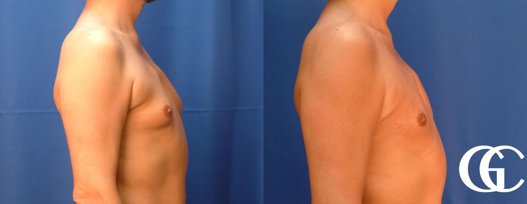 Gynecomastia - Thumbnail 3