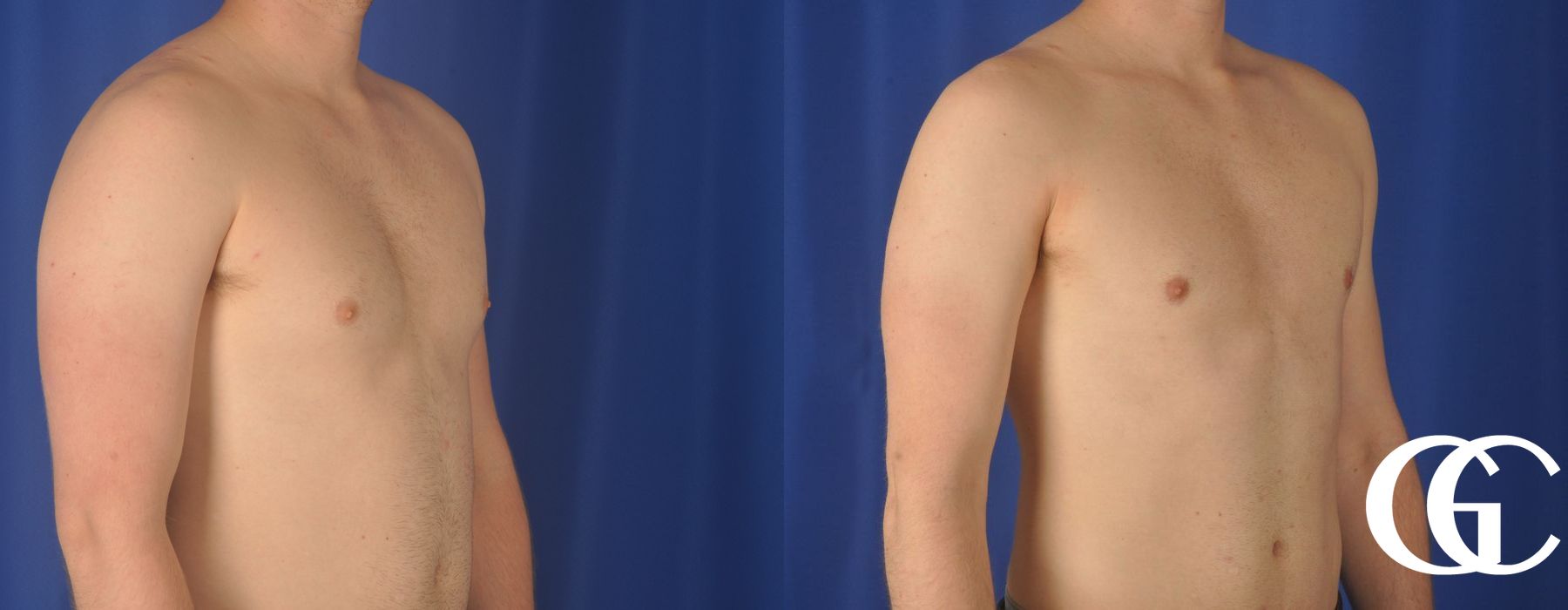 Gynecomastia - Case 7388