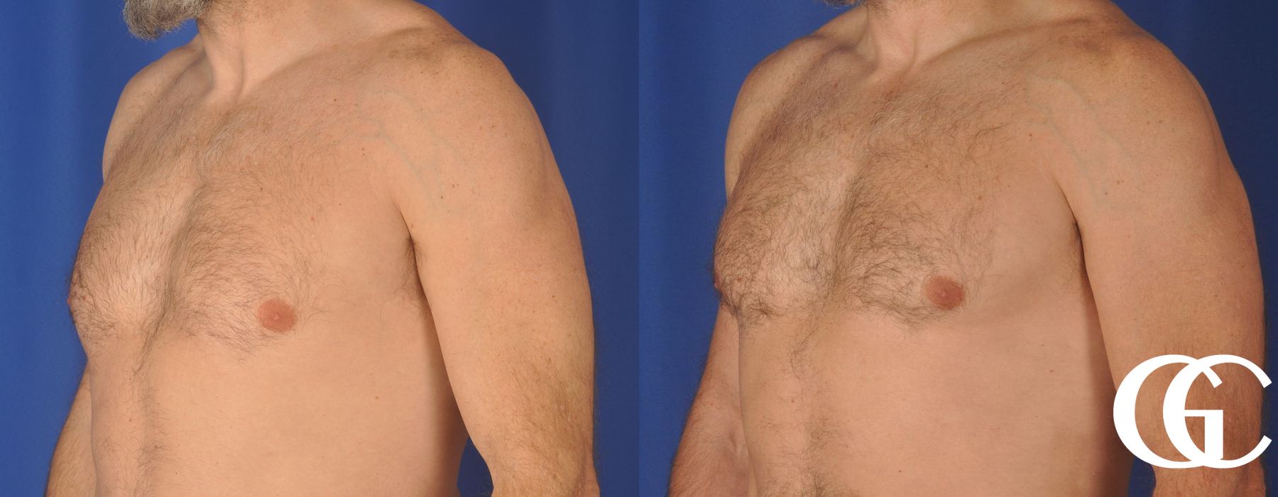 Gynecomastia - Thumbnail 4