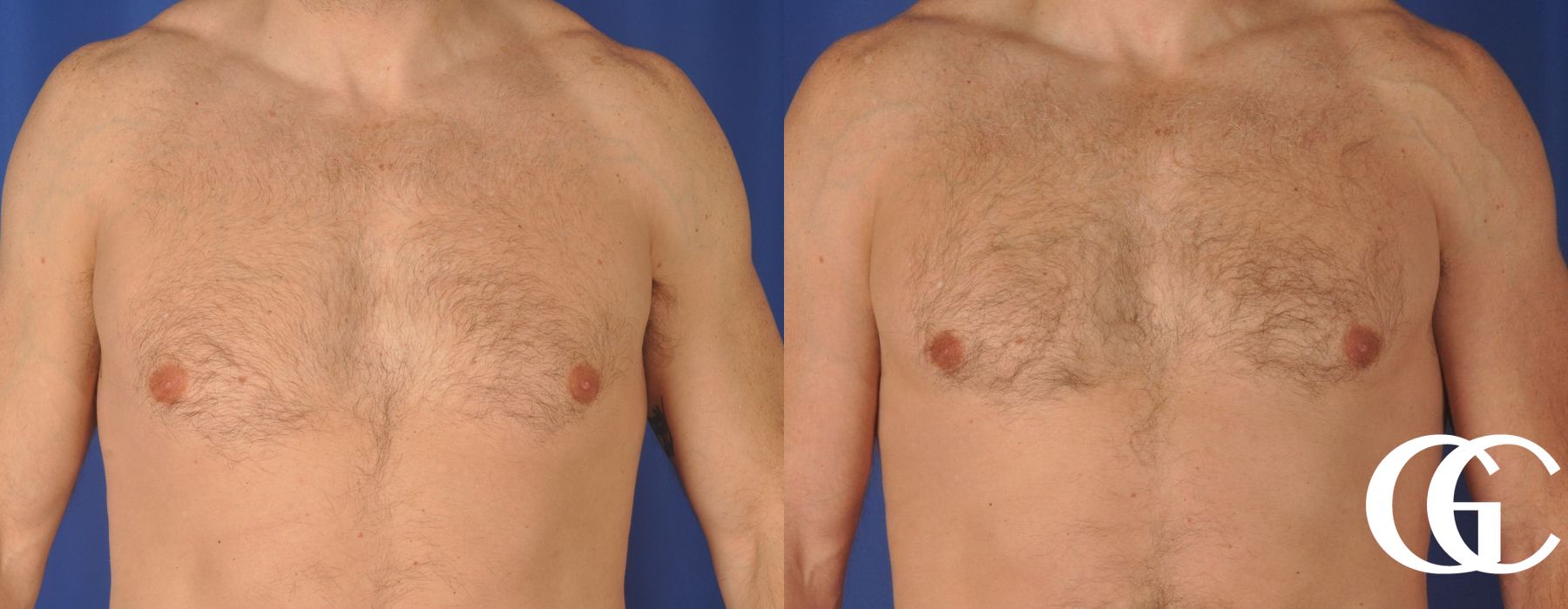 Gynecomastia - Thumbnail 2