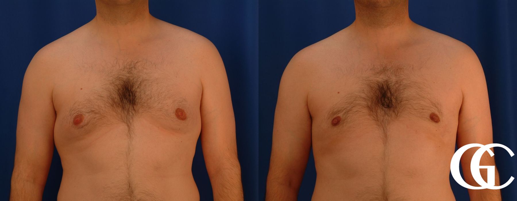 Gynecomastia - Thumbnail 2