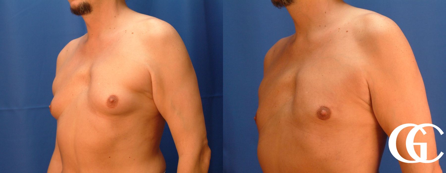 Gynecomastia - Case 7384