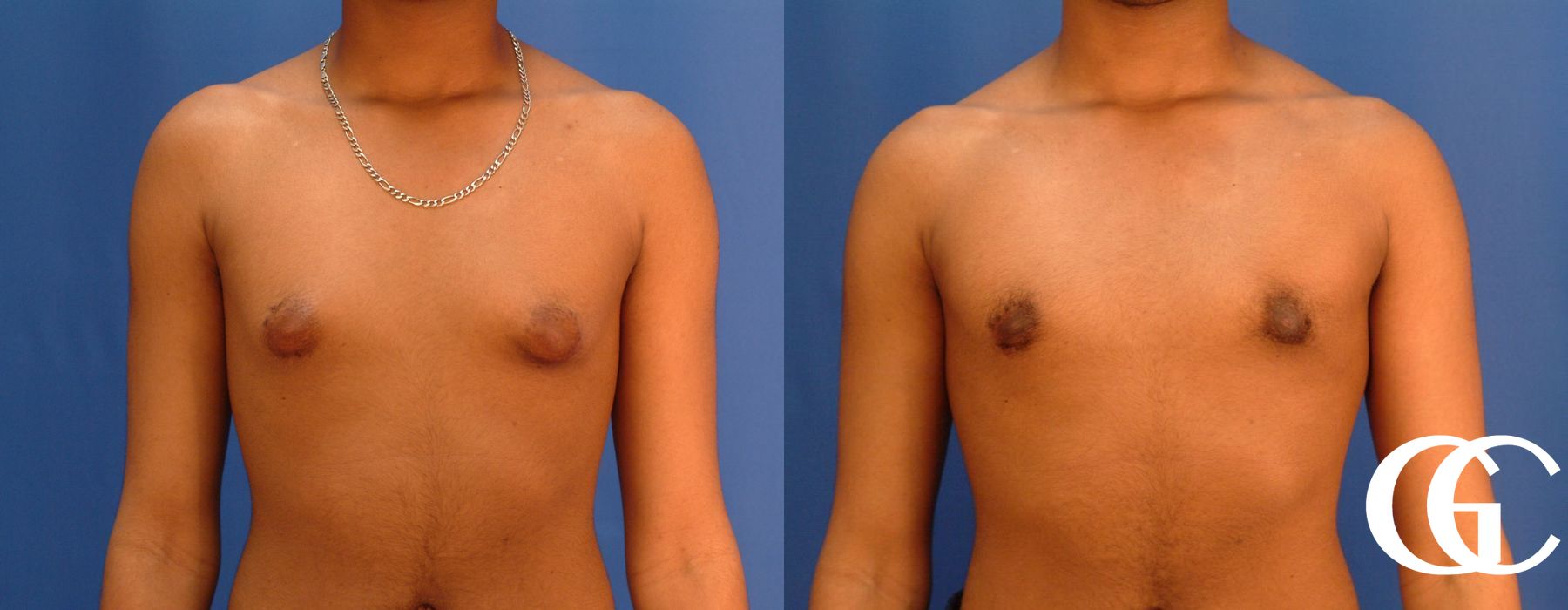 Gynecomastia - Thumbnail 2