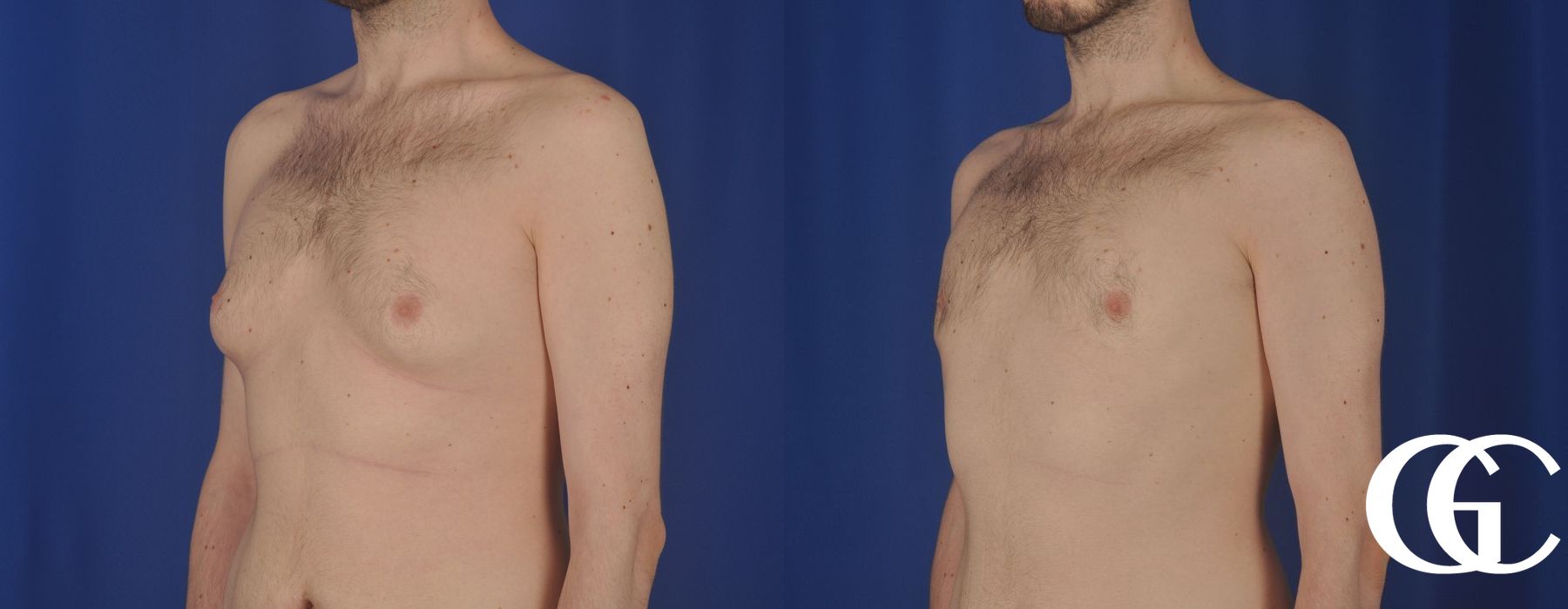 Gynecomastia - Case 7381