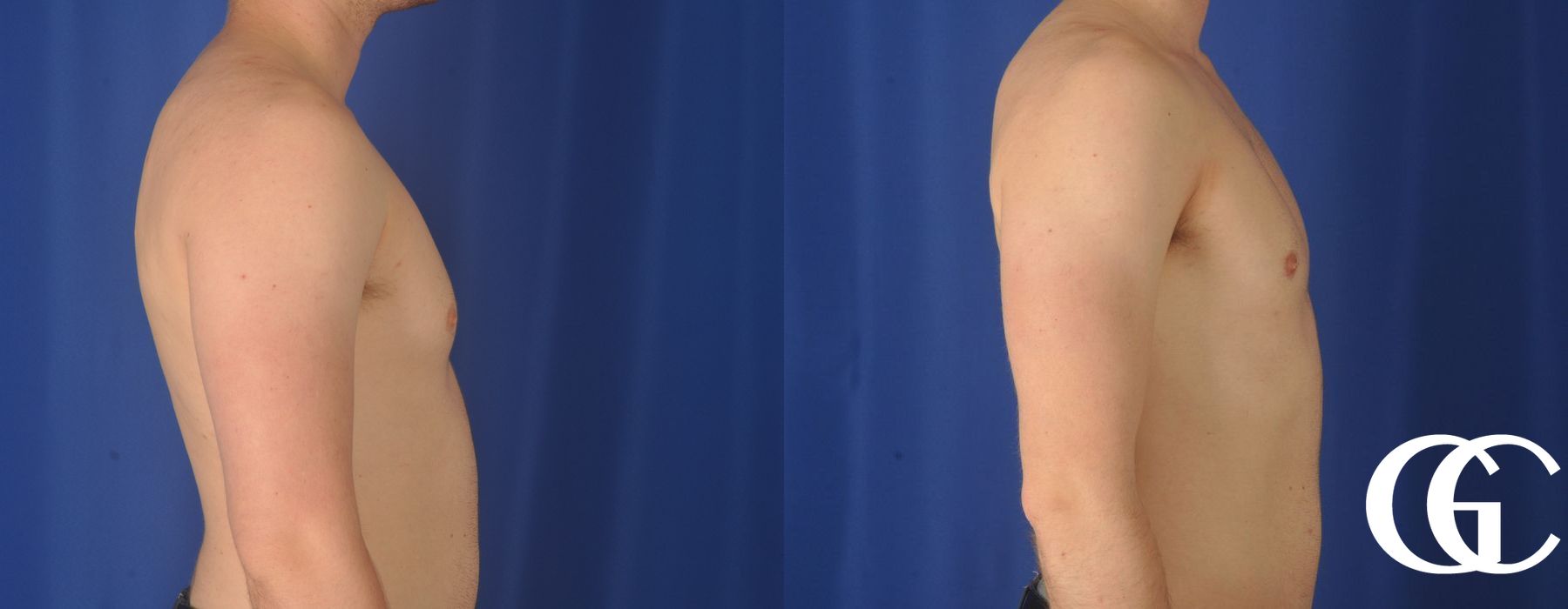 Gynecomastia - Thumbnail 3