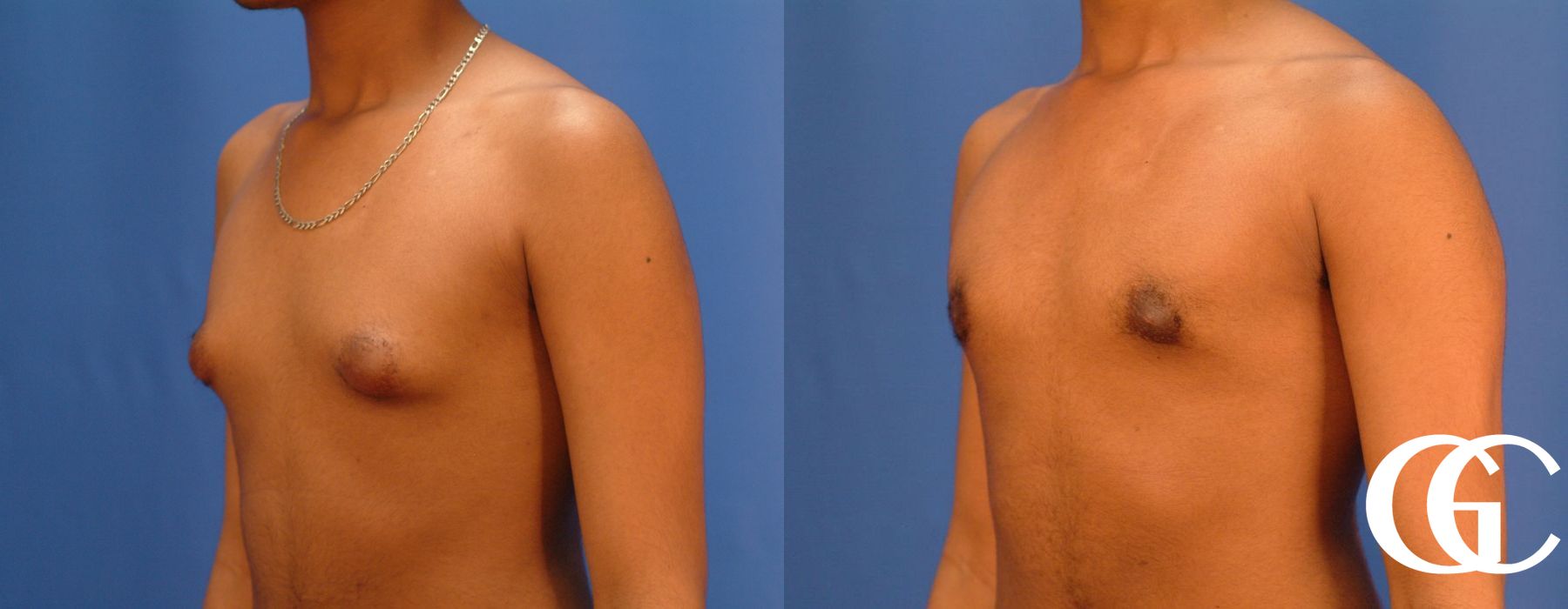 Gynecomastia - Thumbnail 5