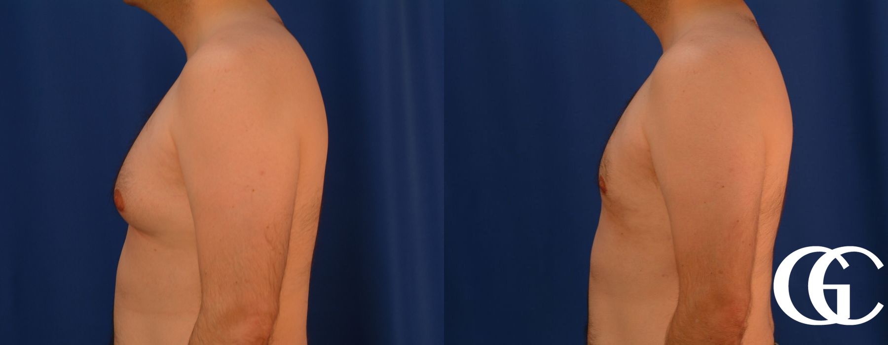 Gynecomastia - Thumbnail 4