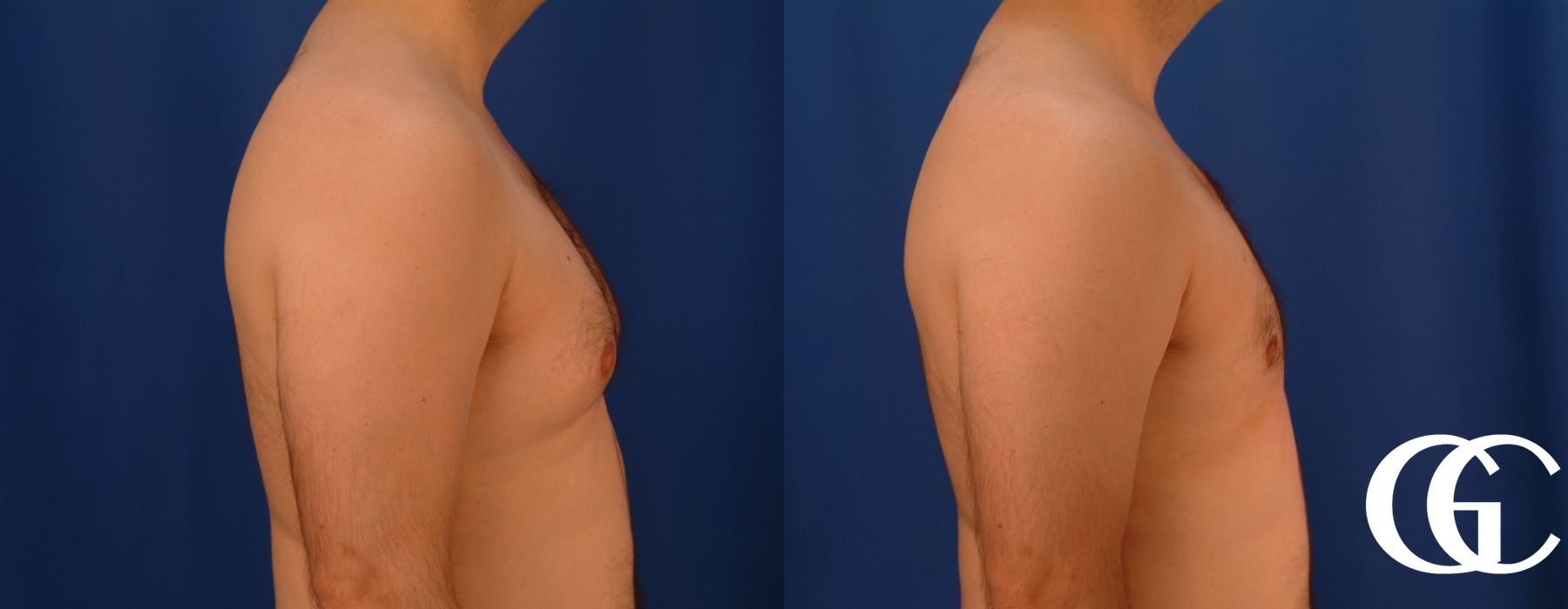 Gynecomastia - Case 7382