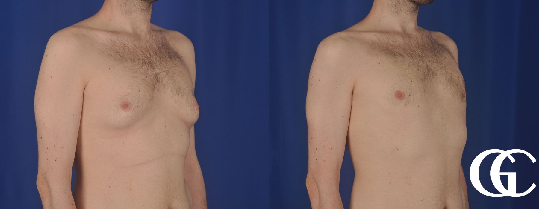 Gynecomastia - Thumbnail 4
