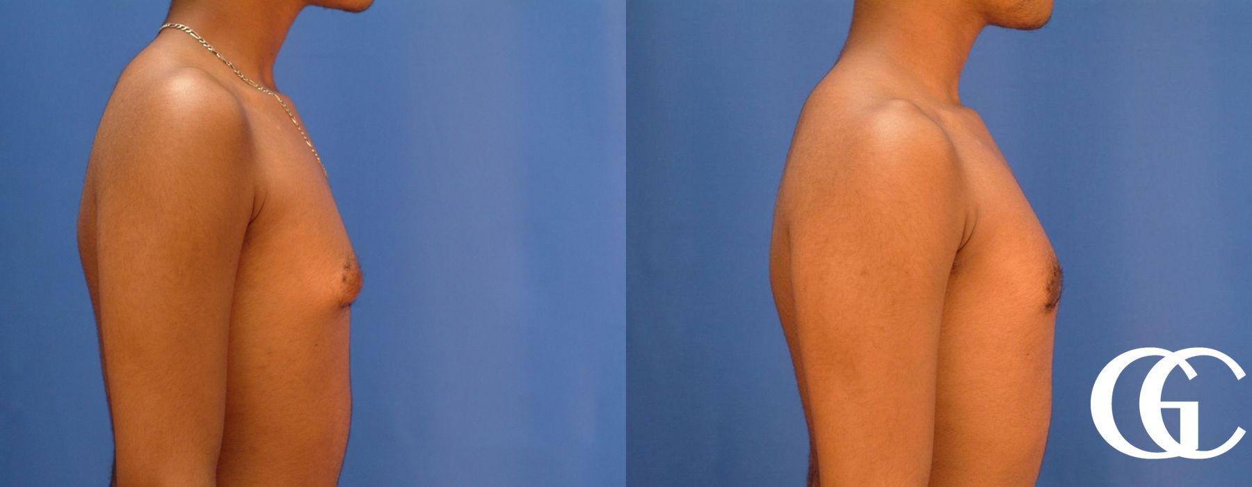 Gynecomastia - Thumbnail 3