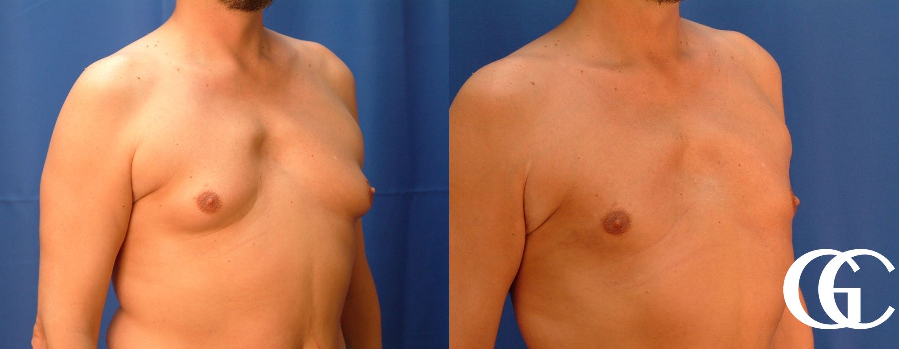 Gynecomastia - Thumbnail 4