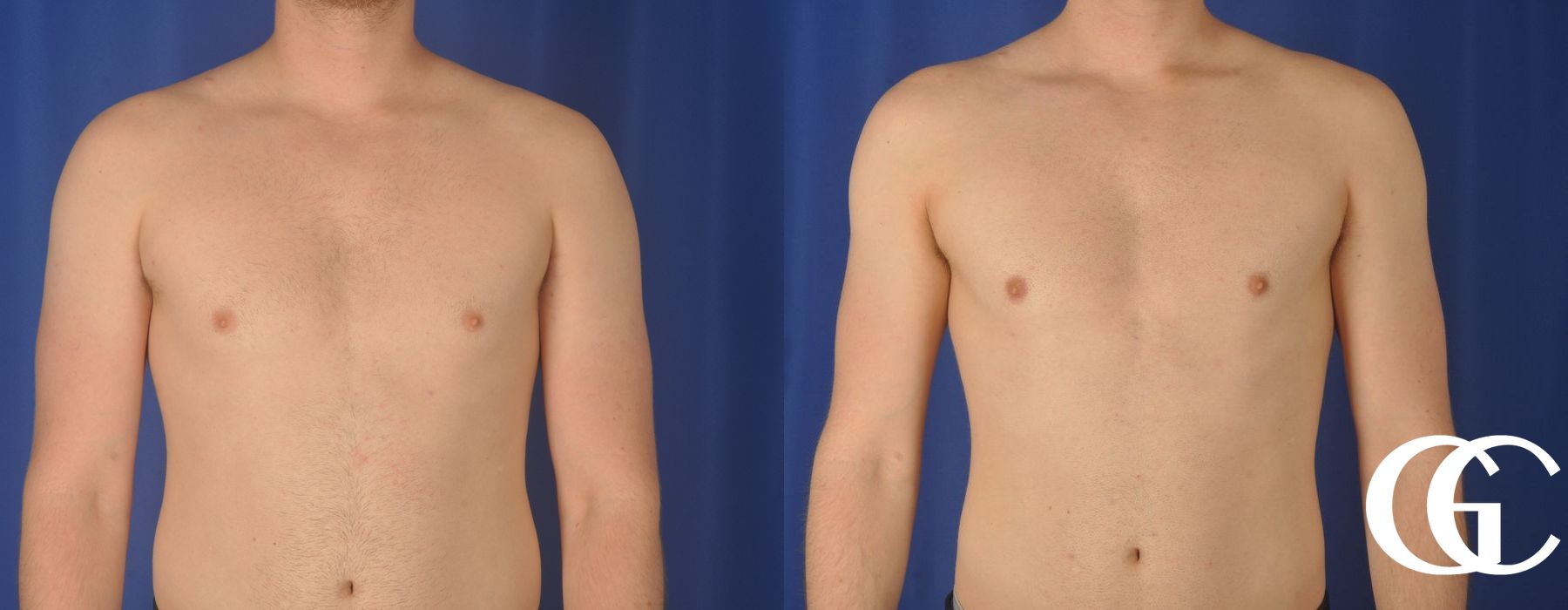 Gynecomastia - Thumbnail 2