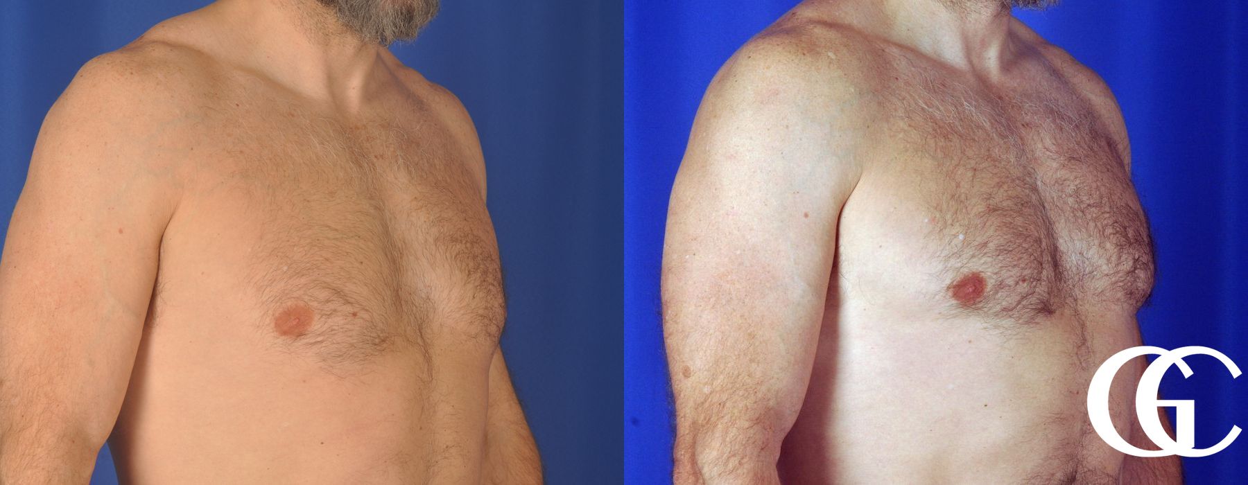 Gynecomastia - Thumbnail 3