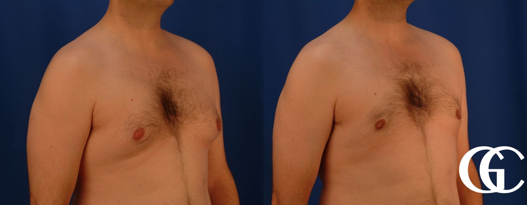 Gynecomastia - Thumbnail 3