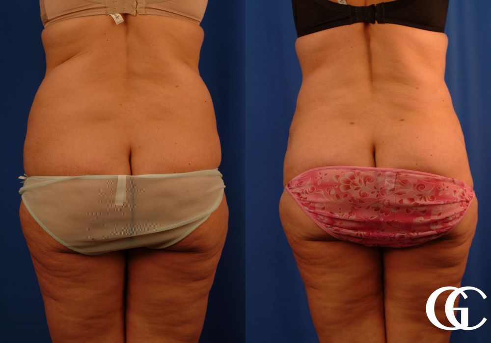 Lipoabdominoplasty - Thumbnail 2