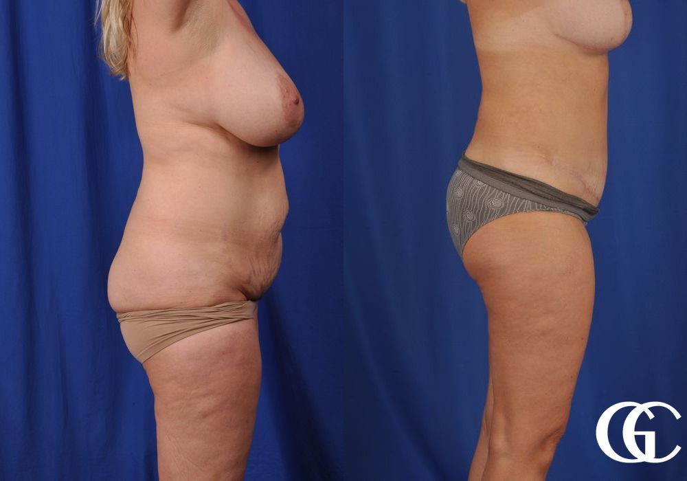 Lipoabdominoplasty - Thumbnail 4