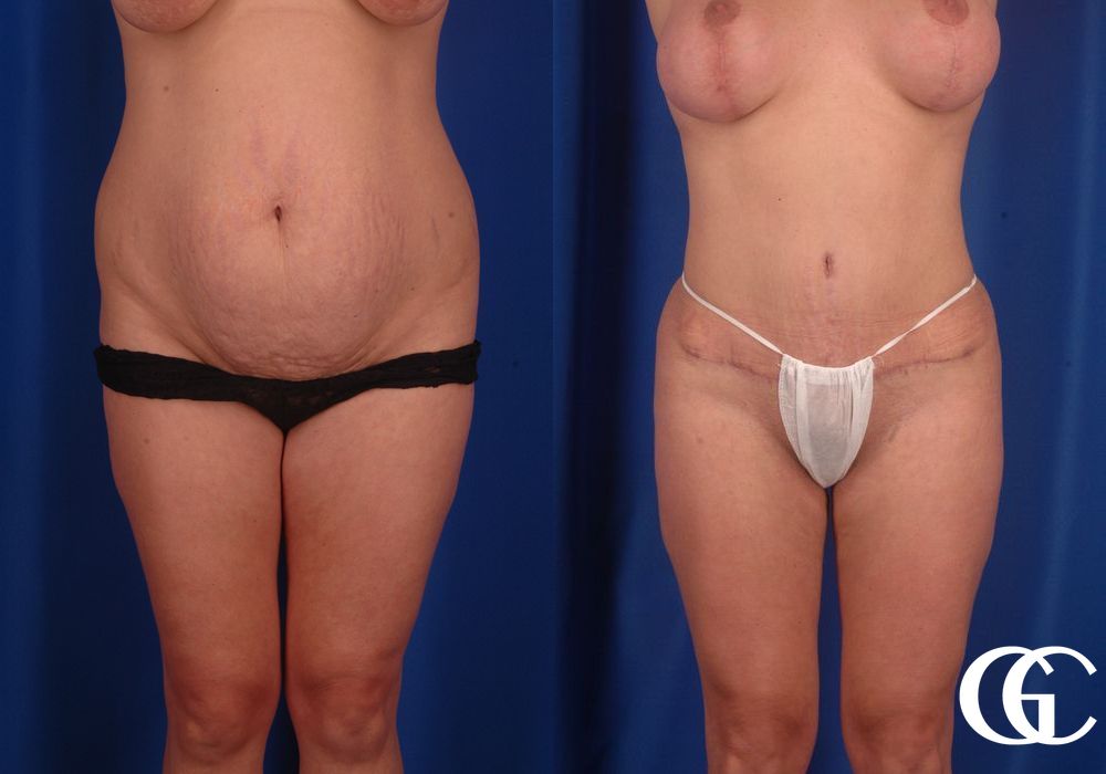 Lipoabdominoplasty - Thumbnail 2