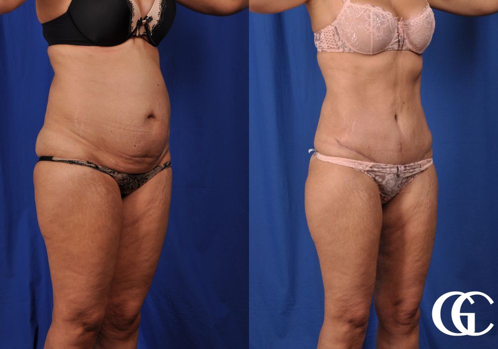 Lipoabdominoplasty - Thumbnail 2