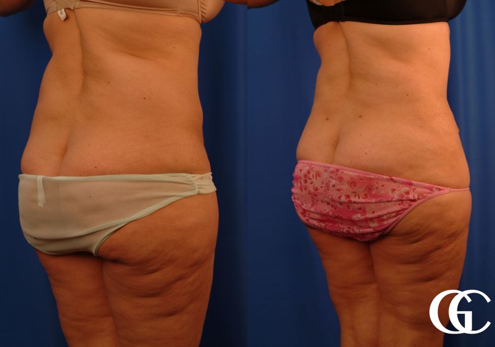 Lipoabdominoplasty - Thumbnail 4