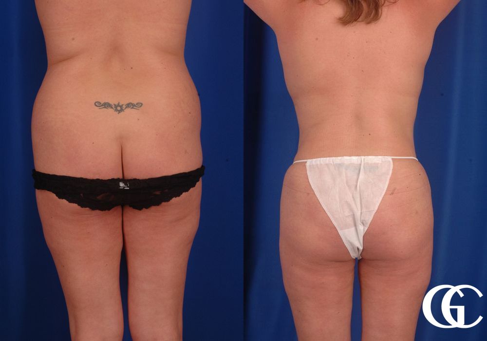 Lipoabdominoplasty - Thumbnail 3