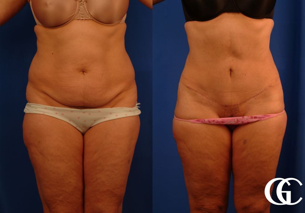 Lipoabdominoplasty - Case 6915