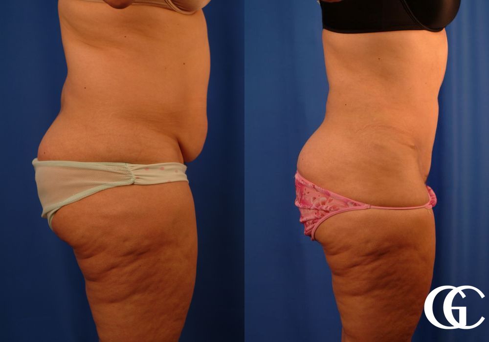 Lipoabdominoplasty - Thumbnail 3