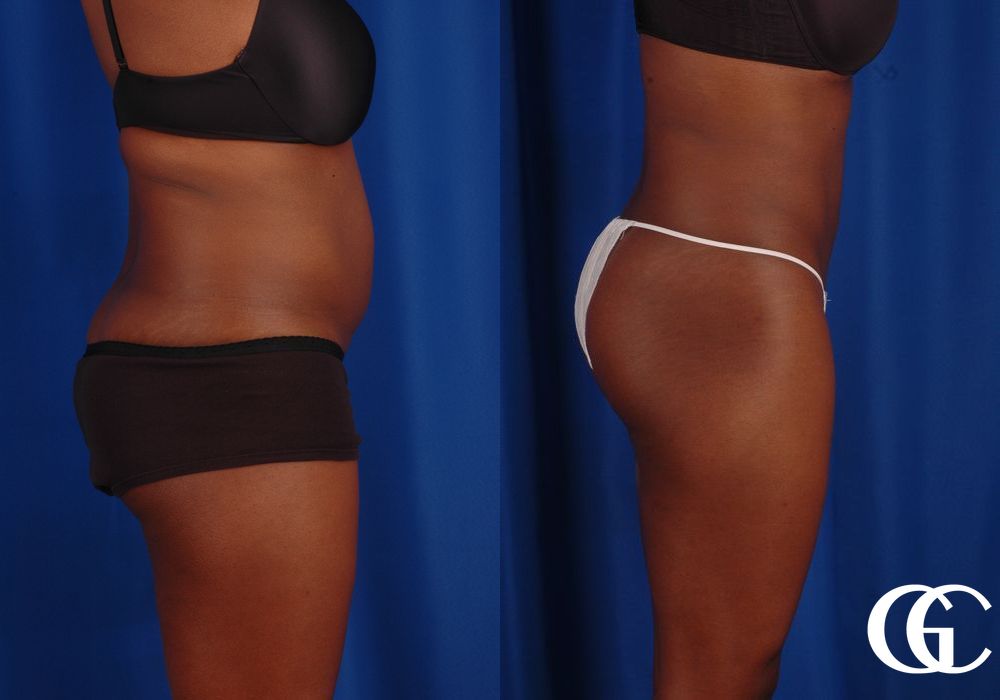 Liposuction - Thumbnail 4