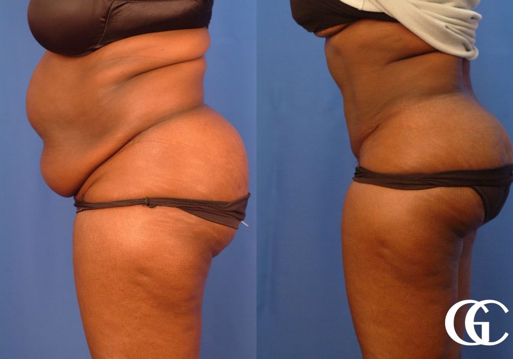Liposuction - Thumbnail 2