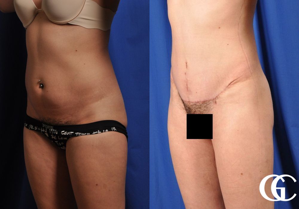 Tummy Tuck - Thumbnail 5